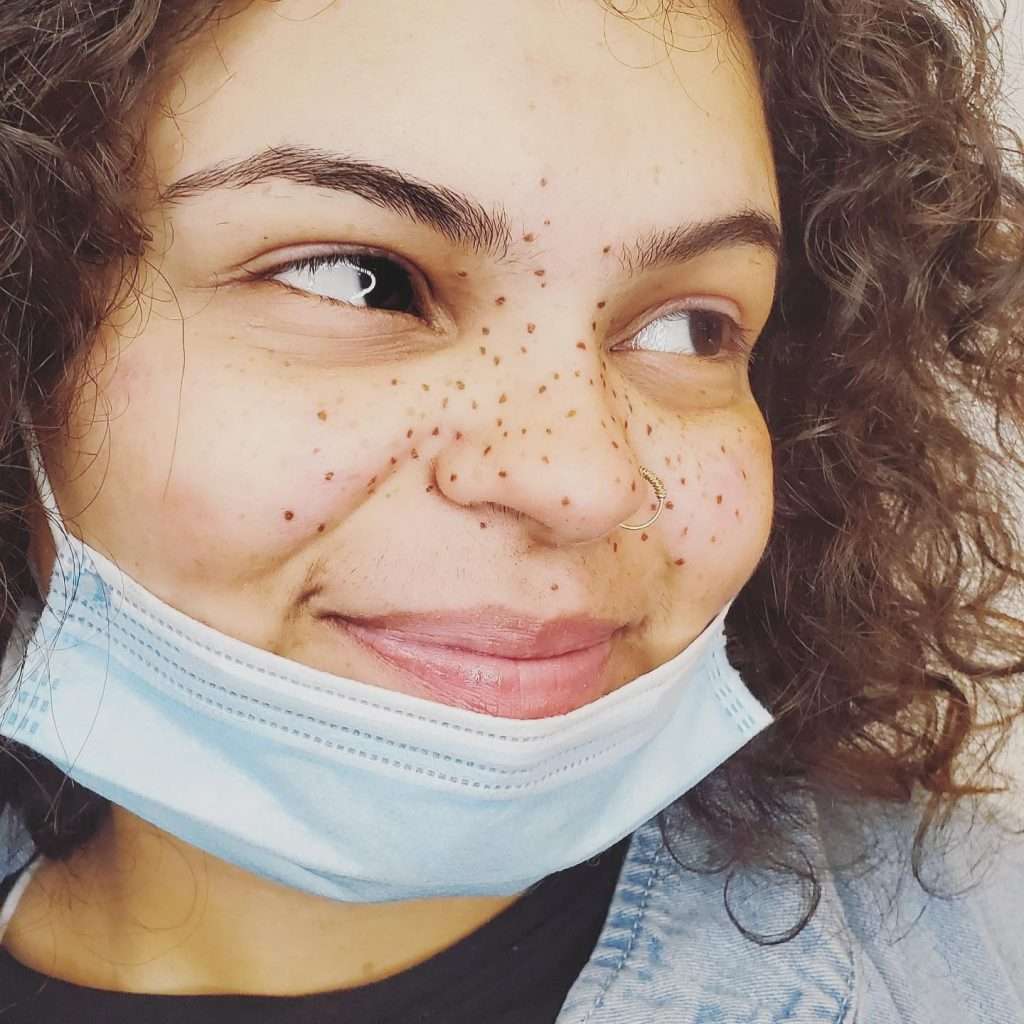 Freckles & Beauty Marks
