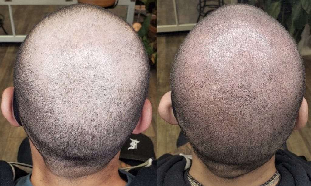 Scalp micropigmentation Philadelphia