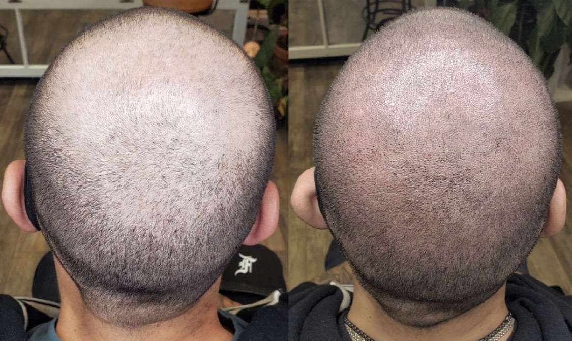 Scalp micropigmentation Philadelphia
