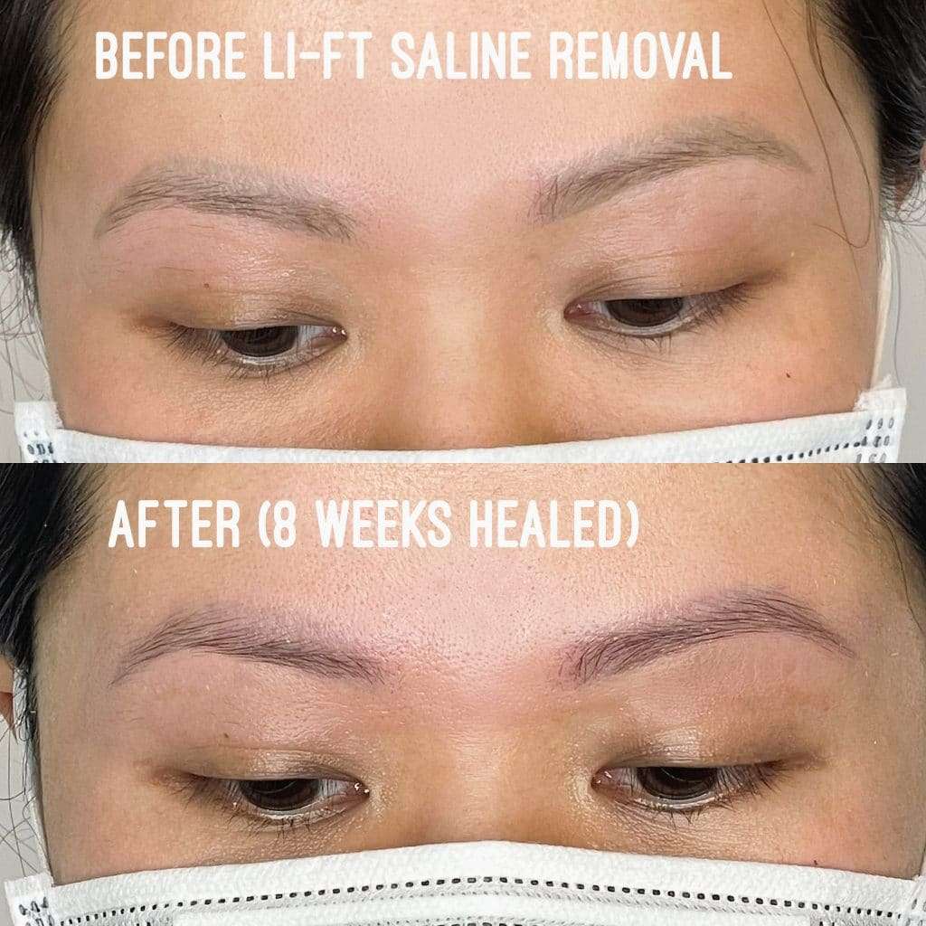 LI-FT saline removal