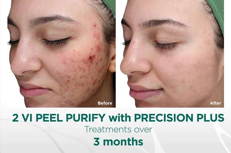 purify with precision plus