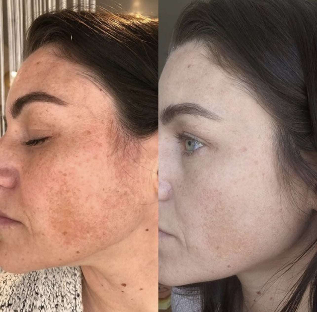 vi peel precision plus