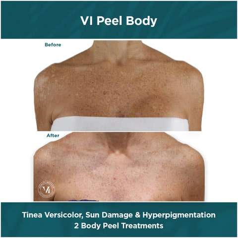 Tina Versicolor, Sun Damage _ Hyperpigmentation